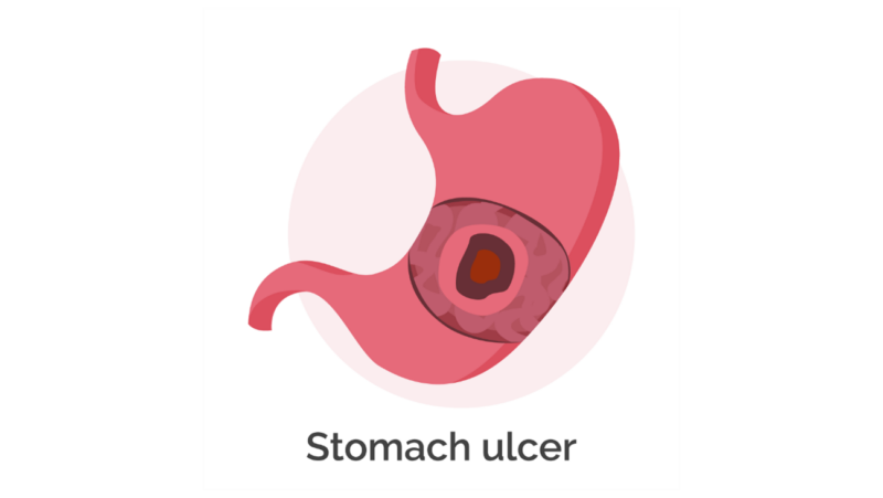 胃潰瘍のアイキャッチ画像