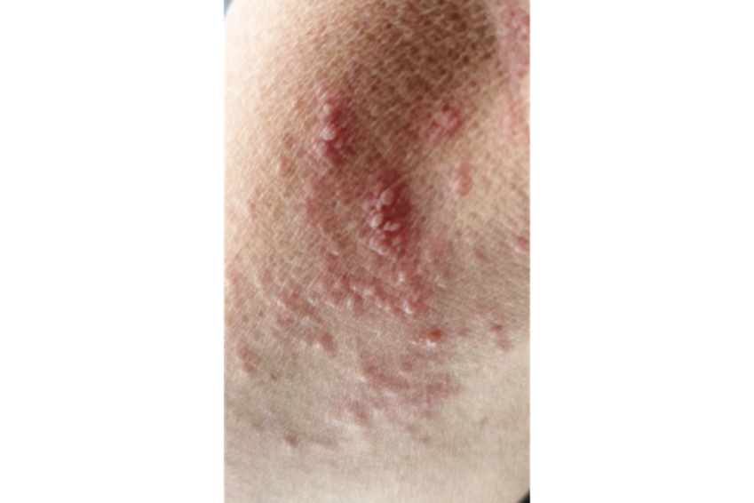 リリカ 帯状 疱疹 – 帯状疱疹 リリカ 用法 | 「リリカ カプセル」 新たな効能・効果を取得 – IJKIIB